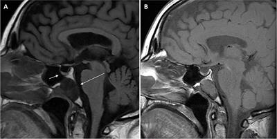 Frontiers A patient with an ectopic sphenoid bone TSH secretory